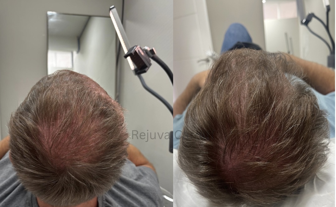Rejuva treatment result