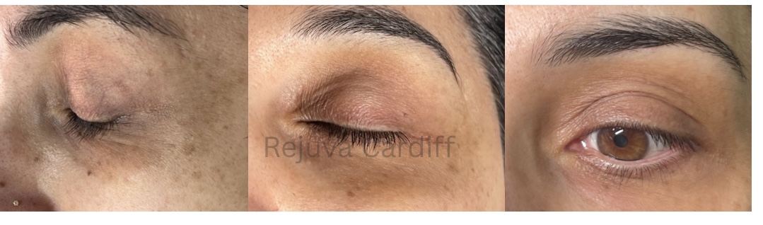 Rejuva hair treatment result