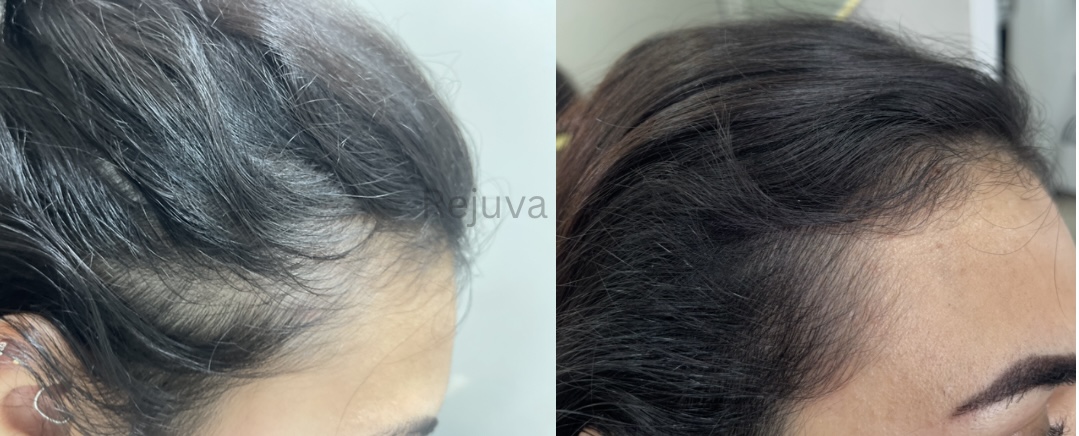 Rejuva hair treatment result